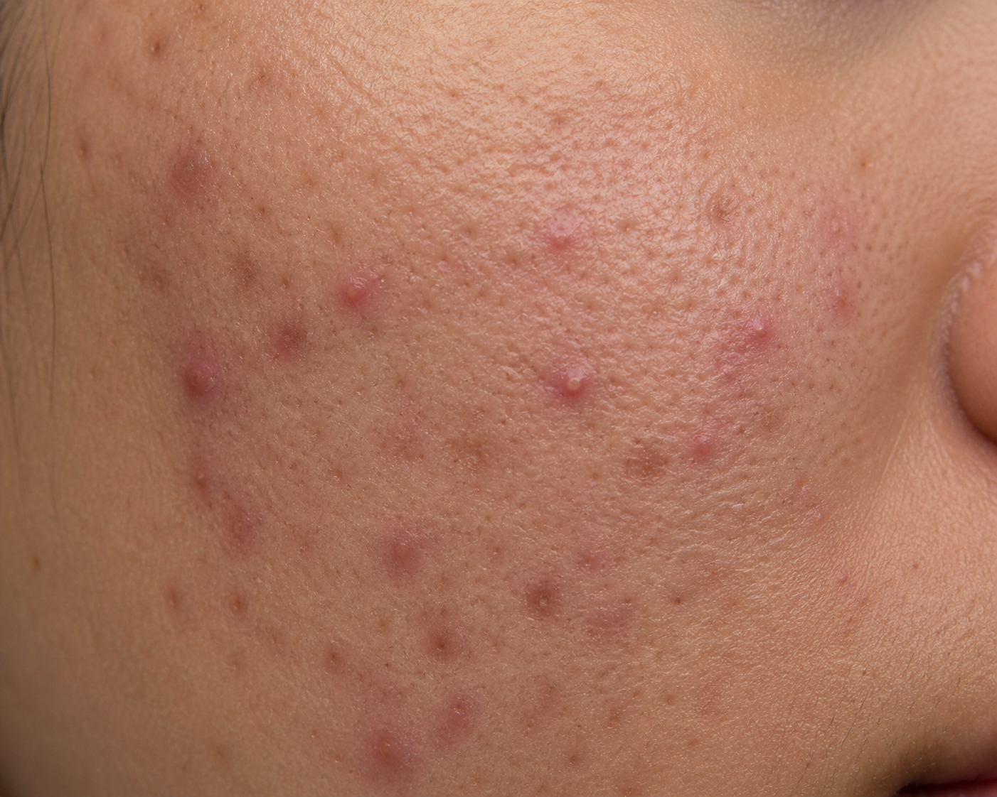 Shop For Acne Solution