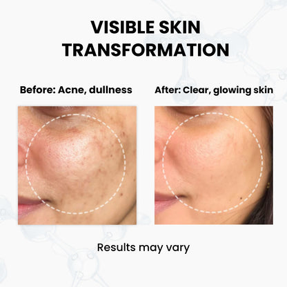 Unik Naturals Face Serum Duo (Pack of 2) – Acne Control & Skin Clarifying Serum