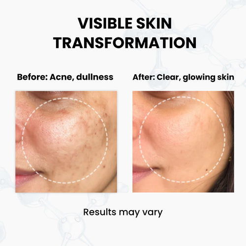 Unik Naturals Acne Control & Skin Clarifying Combo – Face Cleanser + Face Serum
